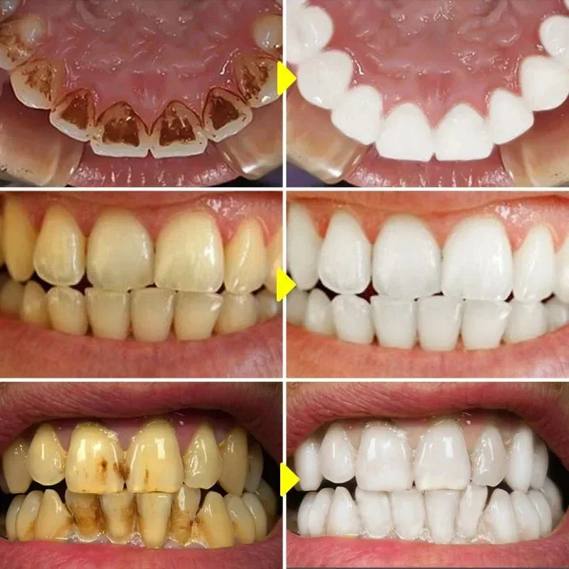 Limpeza eficaz dente branqueamento essência soro, remover placa, dentes amarelos, remoção de manchas, creme dental hálito fresco